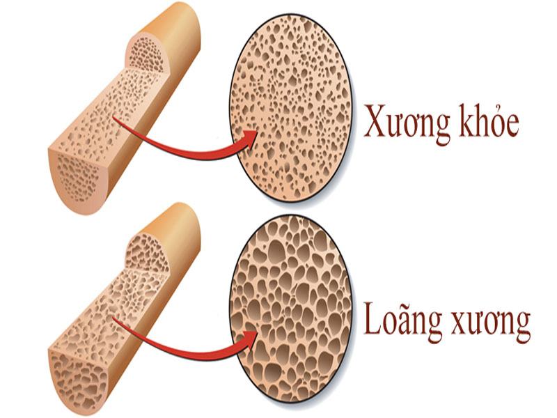 Uống bia tốt cho xương và sức khỏe 